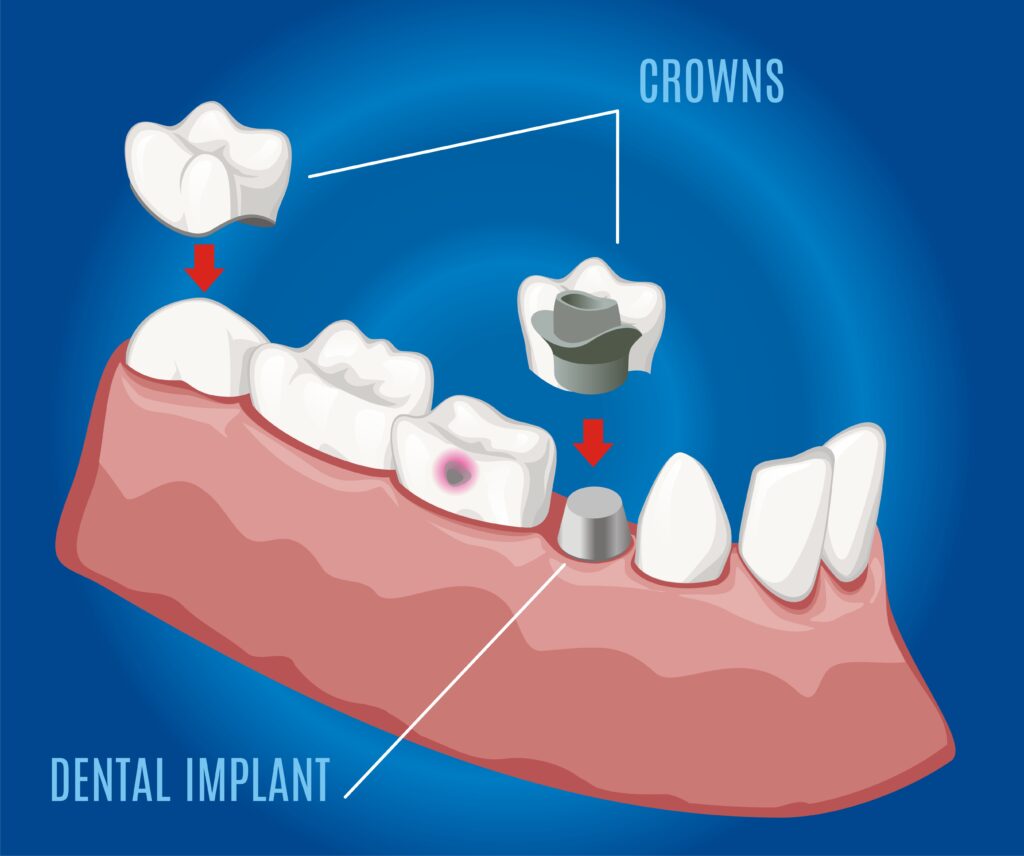 Ridge Augmentation