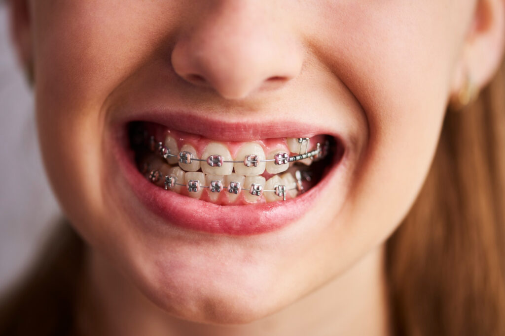 Retainers