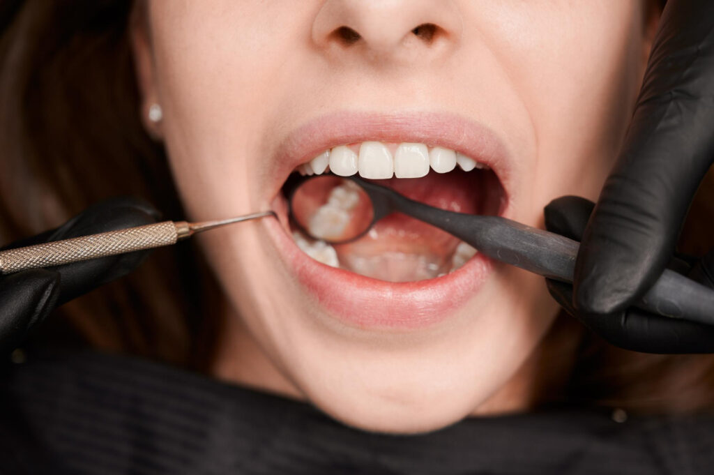 Broken Veneers