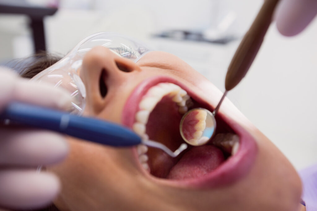 Composite Fillings