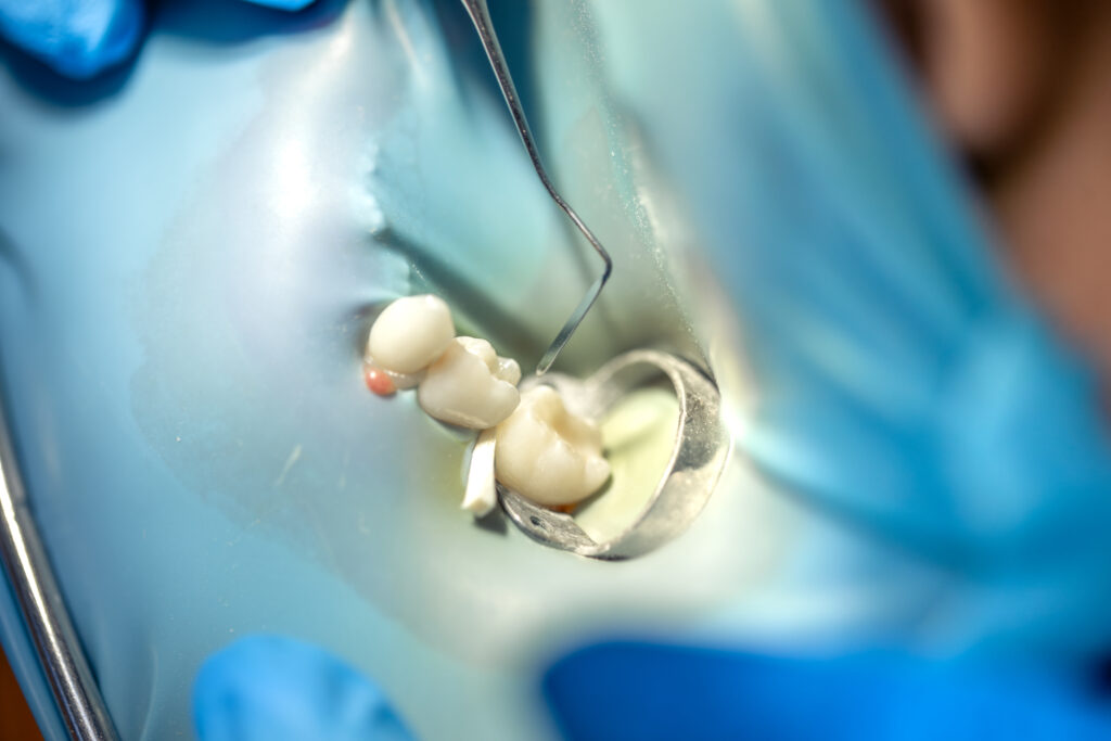 Pulpectomy