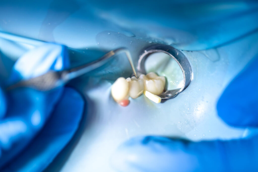 Cavity Reversal