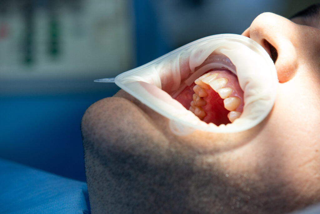 Pulpotomy