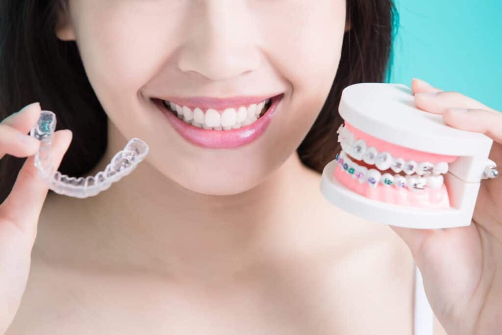 Smilers Clear Aligners