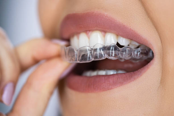 Smilers Clear Aligners